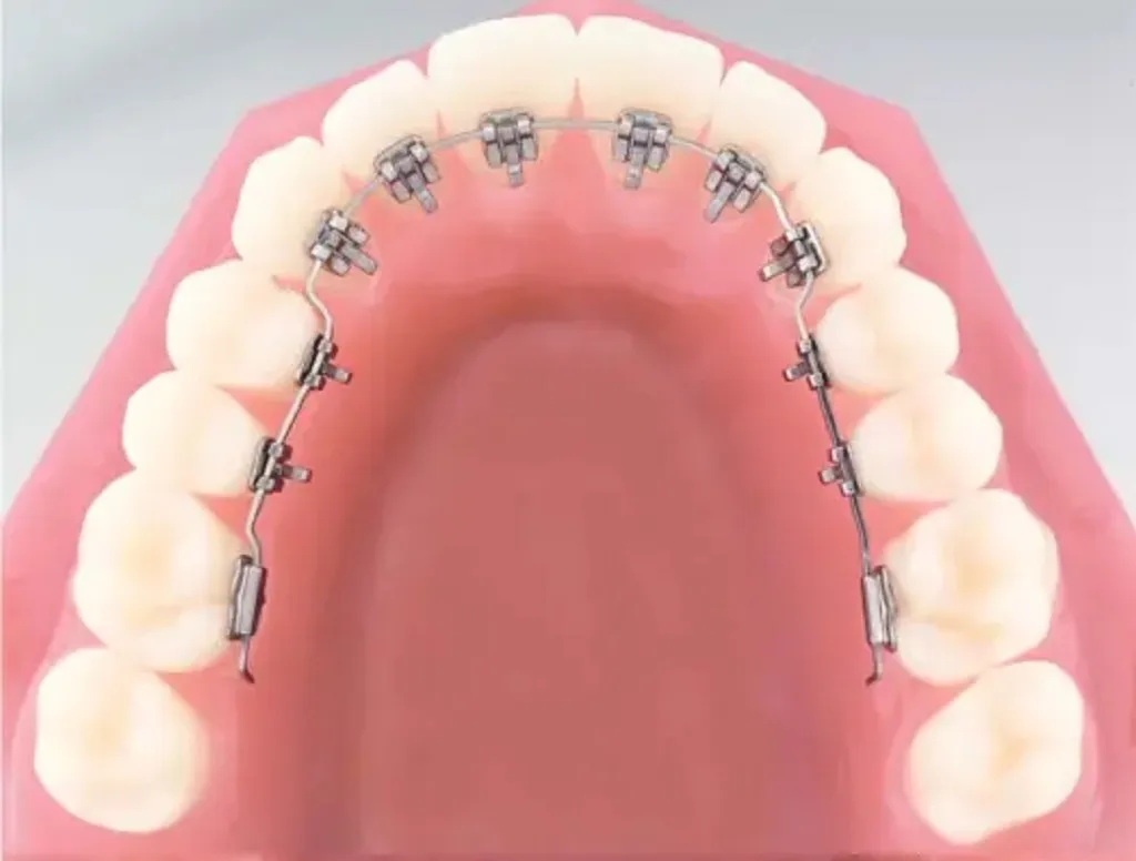 Implanturi dentare inovative pentru refacerea zâmbetului